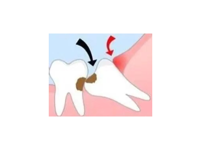吃完飯后老塞牙？別大意！這可能是你的牙齒在報(bào)警