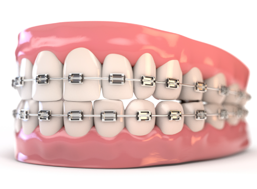 口腔正畸中常見的七個(gè)誤區(qū)