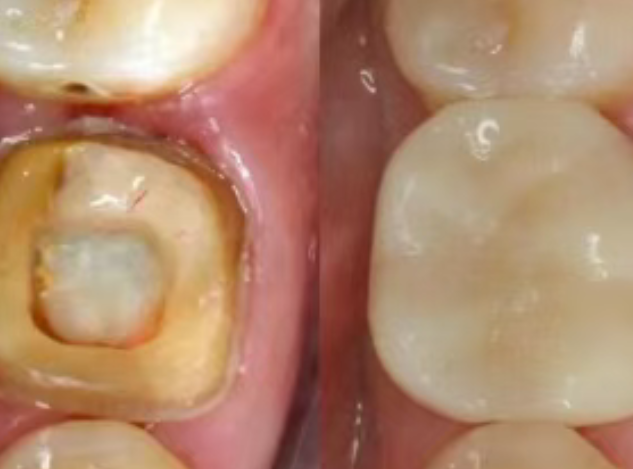 根管治療（抽神經(jīng)）后，為什么一定要做牙冠？