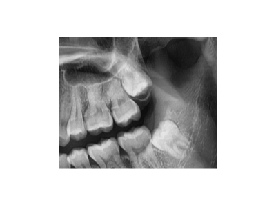 既然「智齒」不宜久留，為什么不能一次性拔掉？